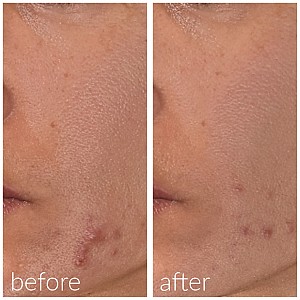 Meso’me Clear – Ορός Καθαρισμού + Roller Microneedling