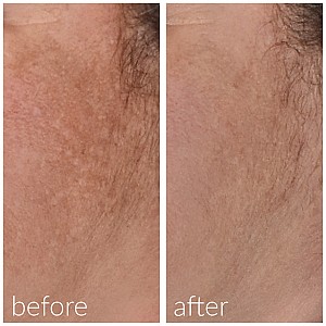 Meso’me Radiance – Ορός Λάμψης + Roller Microneedling