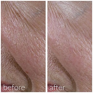 Meso’me Tight – Αντιγηραντικός Ορός + Roller Microneedling